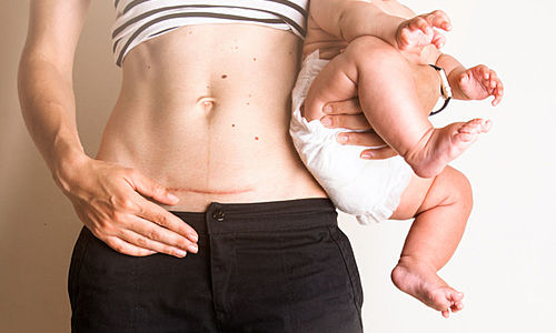 Pencegahan Keloid Pasca Operasi Sectio Caesarea